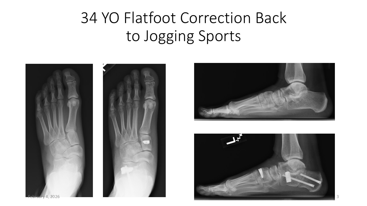 34 YO Flatfoot Correction Back To Jogging Sports