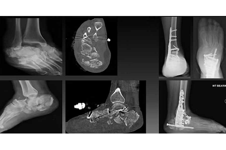 45 Year Old With Severely Crushed Ankle Bone And Heel Bone Undergoing A Salvage Fusion To Avoid Amputation