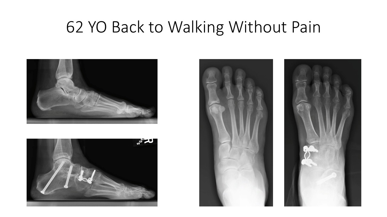 62 YO Back To Walking Without Pain