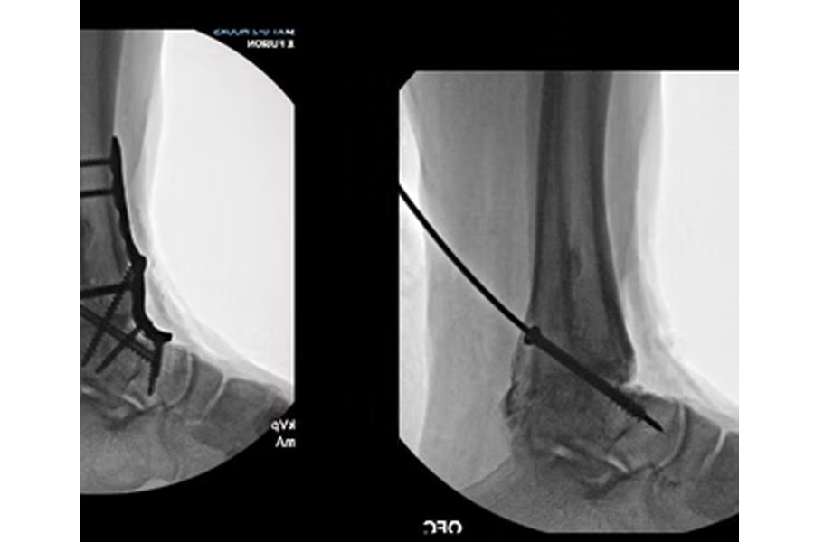 66 Year Old Male Ankle Fusion