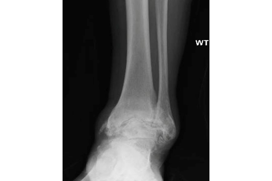 72 YO With Severely Arthritic Angulated Ankle