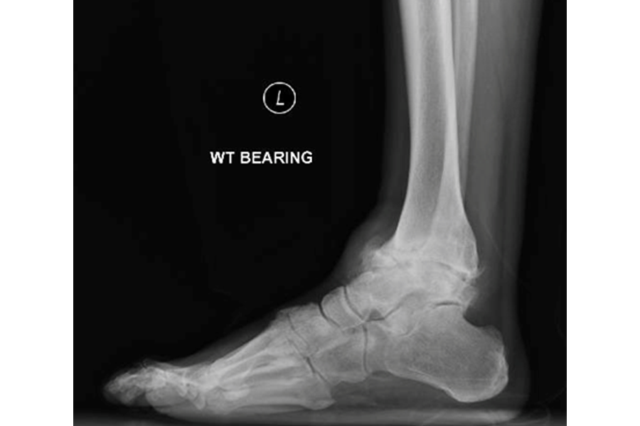 72 YO With Severely Arthritic Angulated Ankle