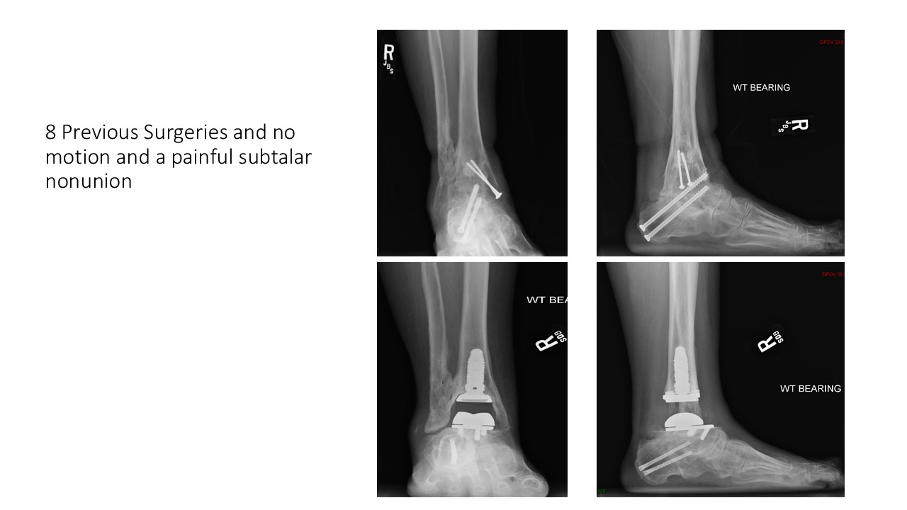8 Previous Surgeries And No Motion And A Painful Subtalar Nonunion