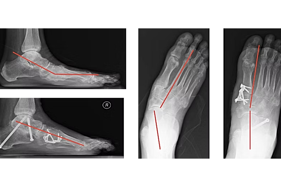 80 Year Old Male Gastrocnemius Recession Tibia Bone Graft Harvest Subtalar Fusion Ptt Resection And Fdl Tendon Transfer Deltoid Ligament Repair Midfoot Fusion