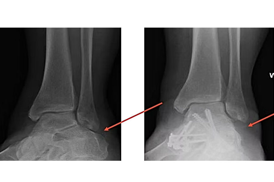 80 Year Old Male Gastrocnemius Recession Tibia Bone Graft Harvest Subtalar Fusion Ptt Resection And Fdl Tendon Transfer Deltoid Ligament Repair Midfoot Fusion