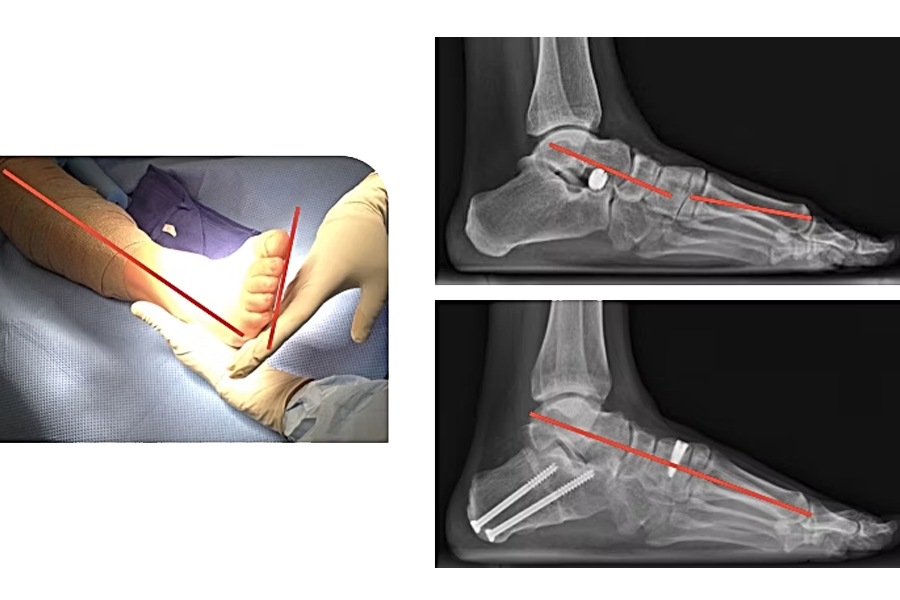 80 Year Old Male Gastrocnemius Recession Tibia Bone Graft Harvest Subtalar Fusion Ptt Resection And Fdl Tendon Transfer Deltoid Ligament Repair Midfoot Fusion