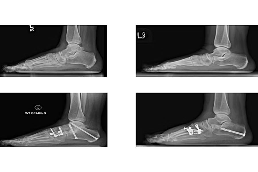 80 Year Old Male Gastrocnemius Recession Tibia Bone Graft Harvest Subtalar Fusion Ptt Resection And Fdl Tendon Transfer Deltoid Ligament Repair Midfoot Fusion