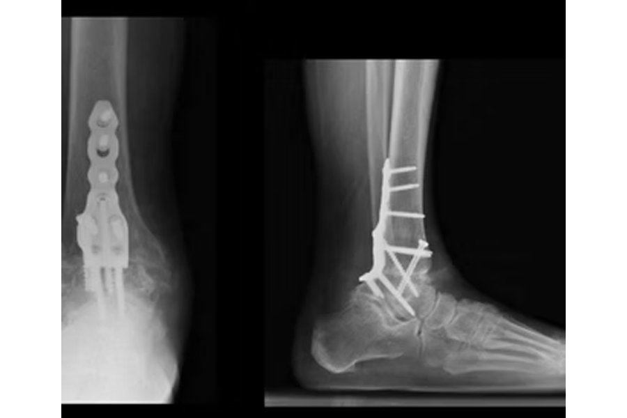 86 Year Old Male Undergoing Fusion With A Posterior Based Plate