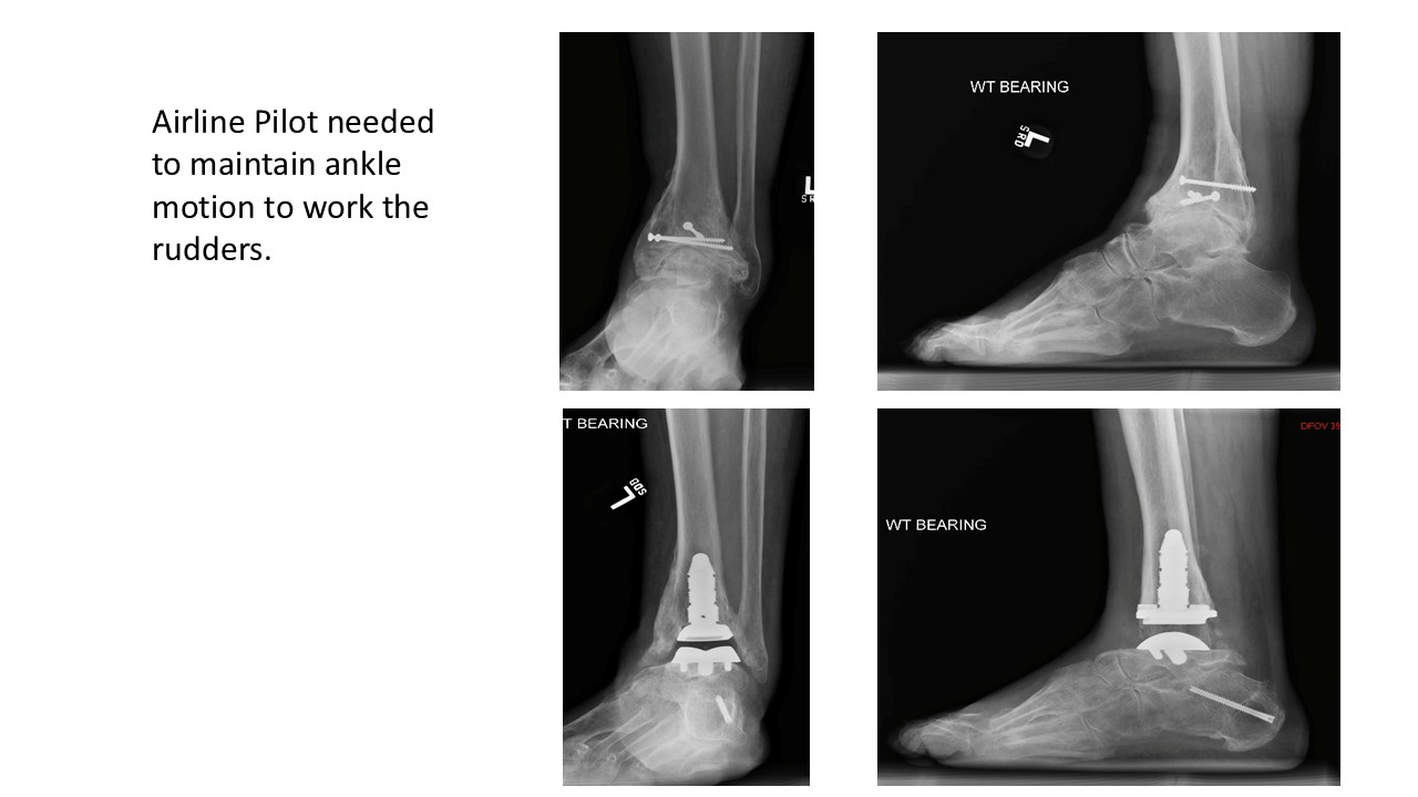 Airline Pilot Needed To Maintain Ankle Motion To Work The Rudders