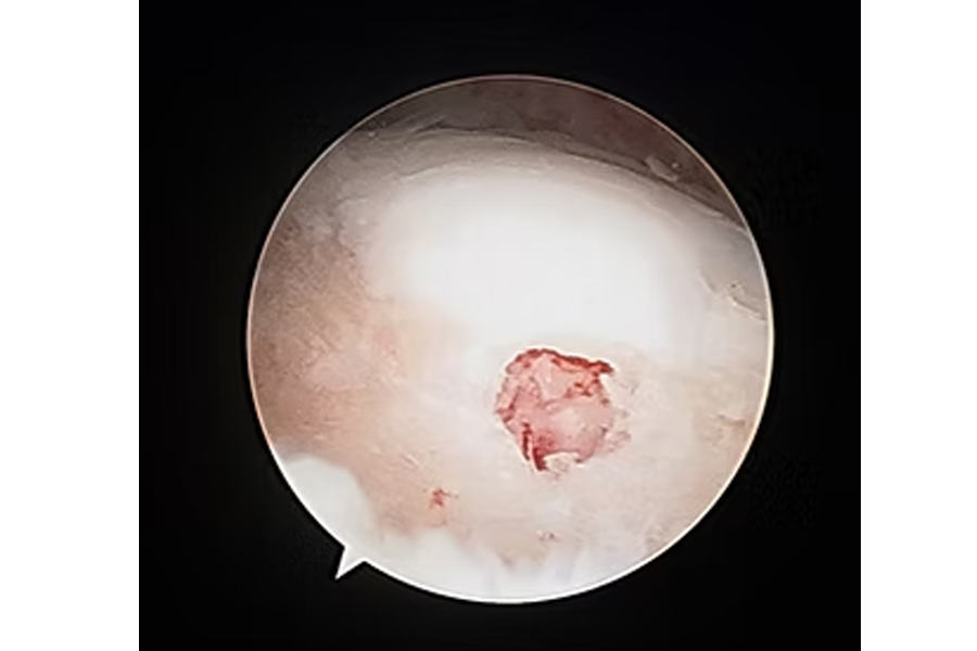 An Osteochondral Lesion Of The Talus With A Full Thickness Cartilage Defect Down To Bone
