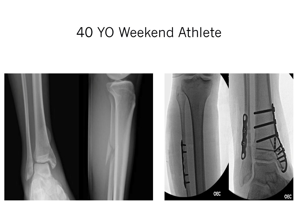 Ankle Fracture 40 YO Weekend Athlete