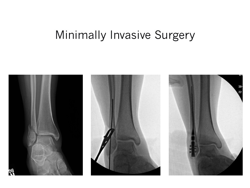 Ankle Fracture Minimally Invasive Surgery