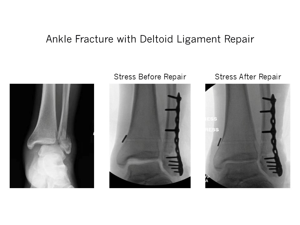 Ankle Fracture With Deltoid Ligament Repair