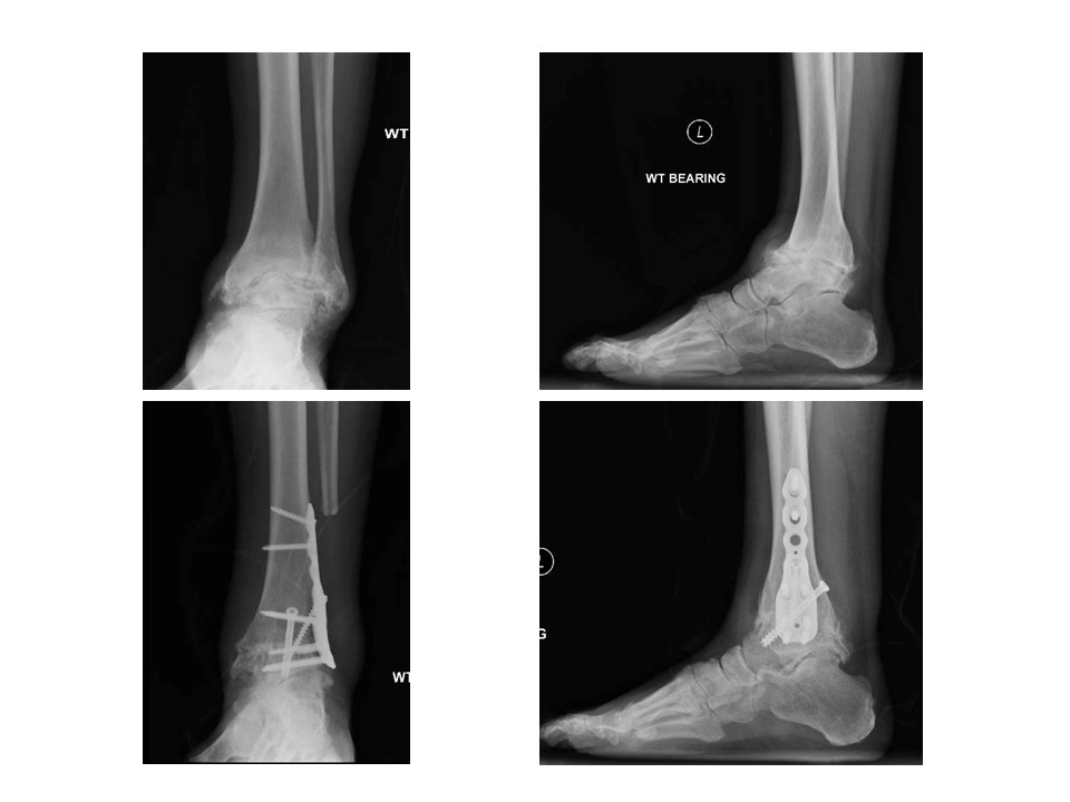 Ankle Fusion Case
