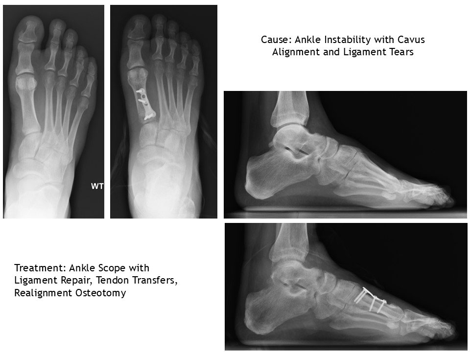 Ankle Instability With Cavus Alignment and Ligament Tears