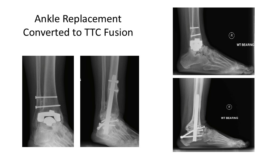 Ankle Replacement Converted To TTC Fusion