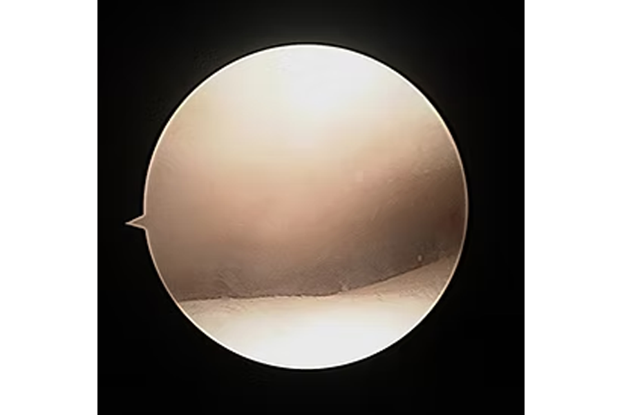 Arthoscopic View Of Healthy Ankle Cartilage