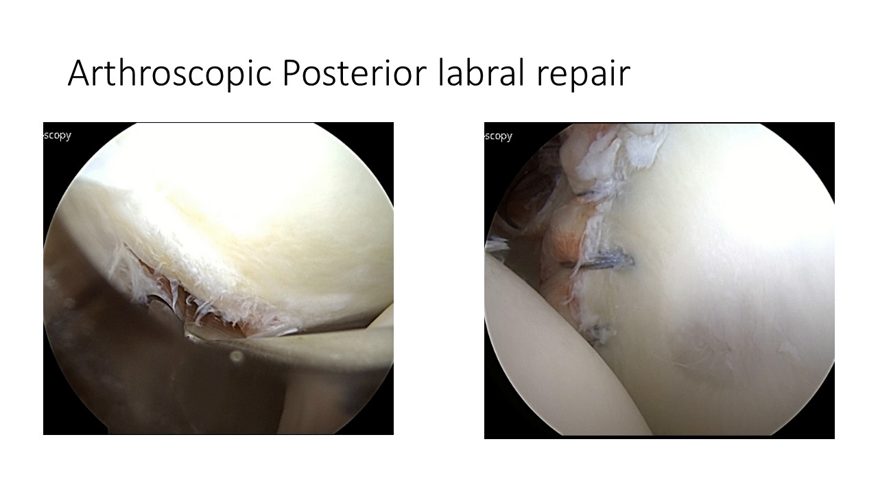 Arthroscopic Posterior Labral Repair