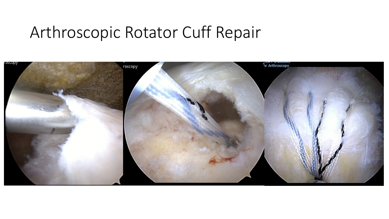 Arthroscopic Rotator Cuff Repair