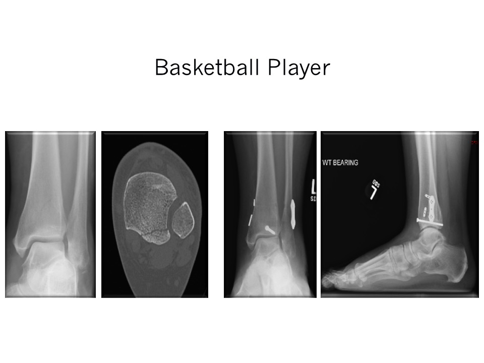 Basketball Player Ankle Fracture Repair