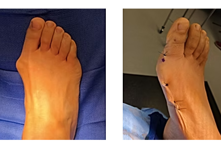 Bunion Correction Through Small Incisions