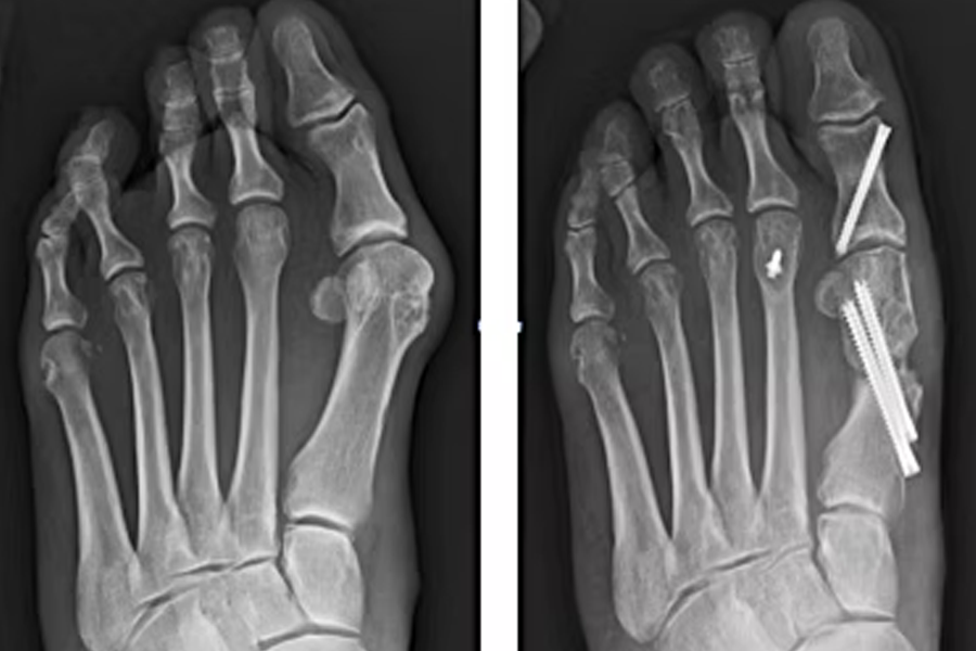 Bunion Correction Through Small Incisions