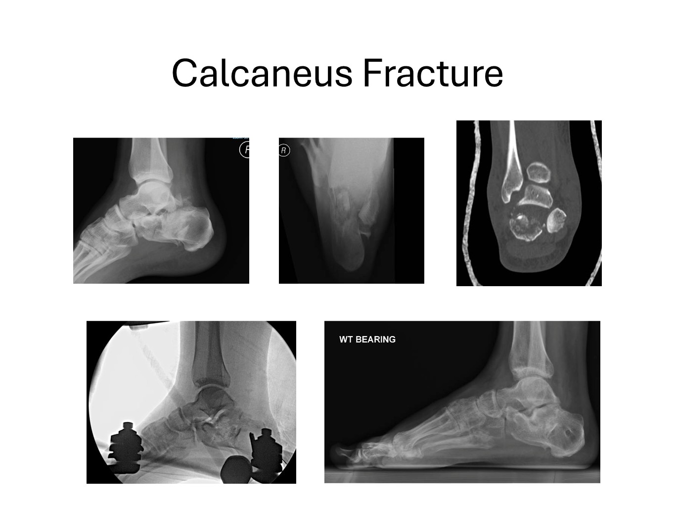 Calcaneus Fracture Case