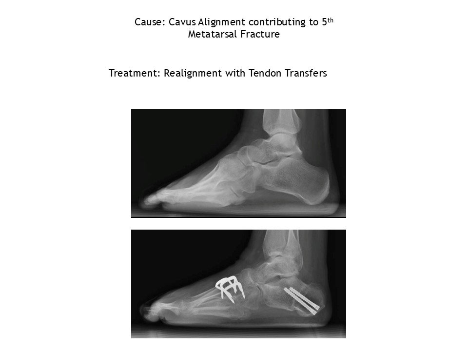 Cavus Alignment Contributing To 5th Metatarsal Fracture