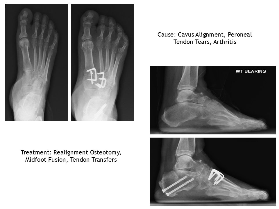 Cavus Alignment Peroneal Tendon Tears Arthritis