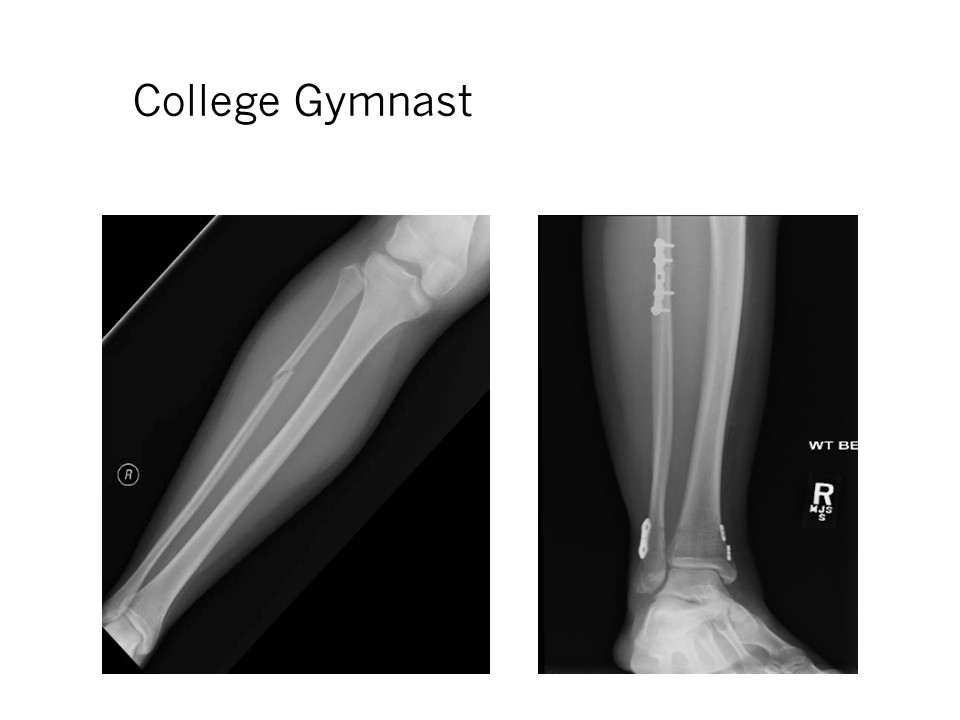 College Gymnast Ankle Fracture Repair