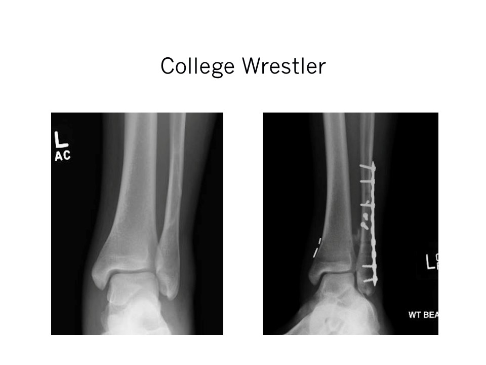 College Wrestler Ankle Fracture Repair