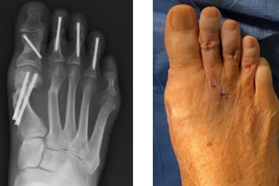 Complete Plantar Plate Repair