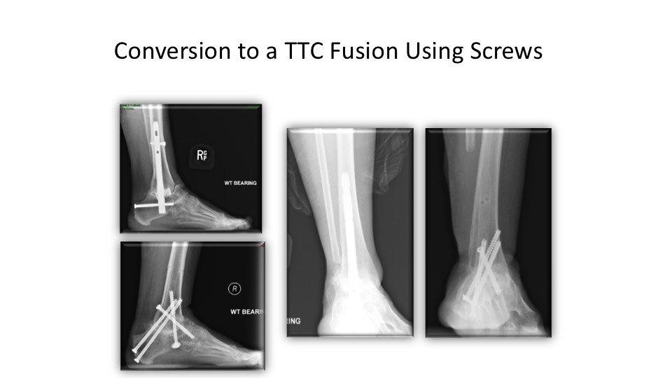 Conversion To A TTC Fusion Using Screws