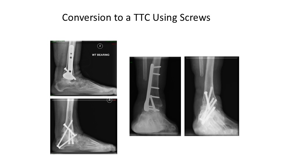 Conversion To A TTC Using Screws