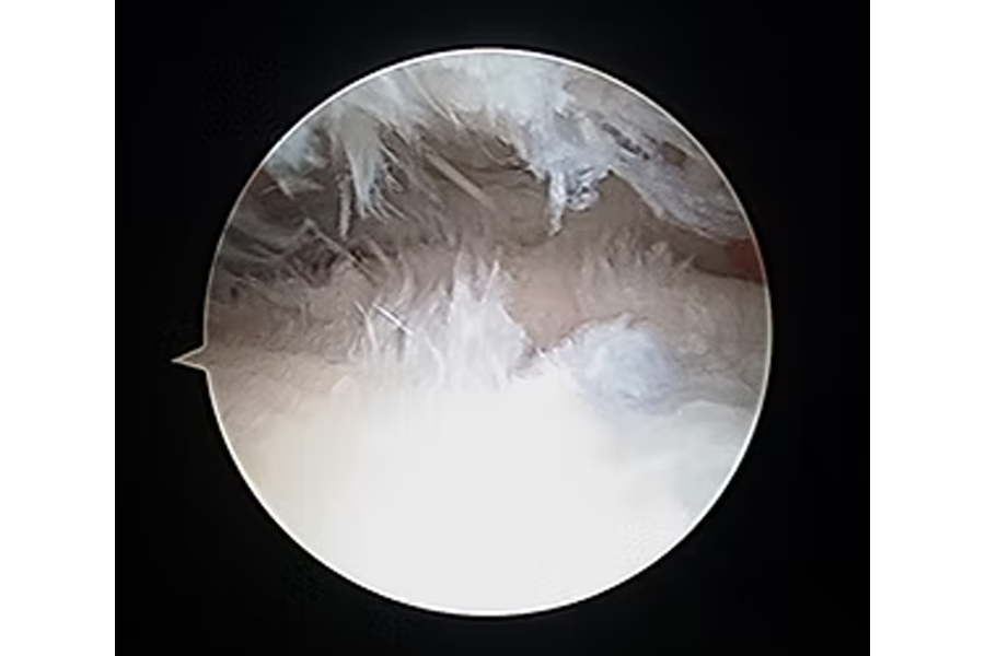 Damaged Cartilage With Fraying