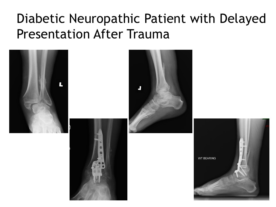 Diabetic Neuropathic Patient With Delayed Presentation After Trauma