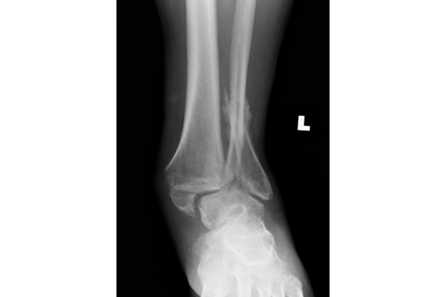 Diabetic Neuropathic Patient with Delayed Presentation After Severe Fracture