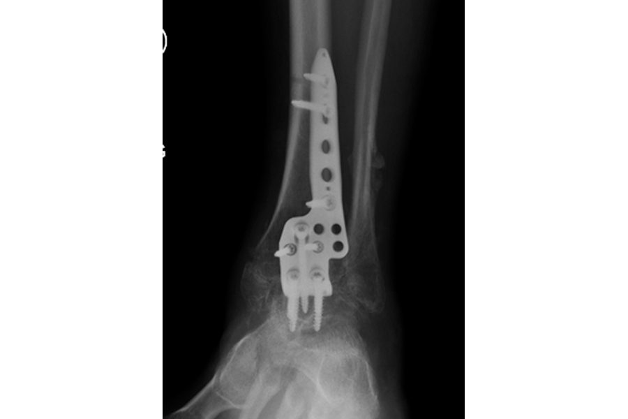 Diabetic Neuropathic Patient with Delayed Presentation After Severe Fracture