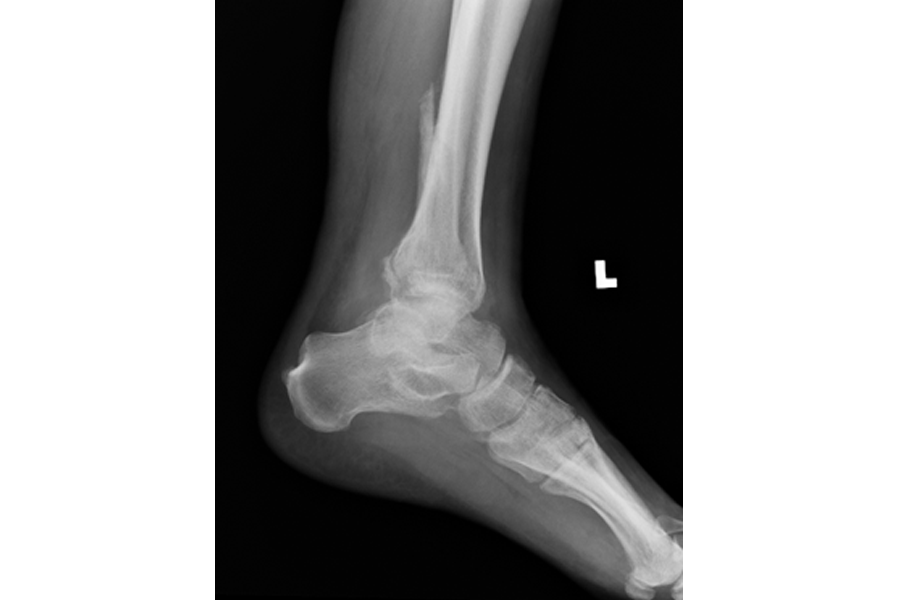 Diabetic Neuropathic Patient with Delayed Presentation After Severe Fracture