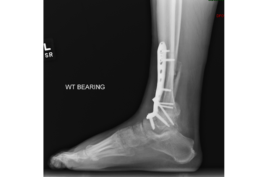 Diabetic Neuropathic Patient with Delayed Presentation After Severe Fracture