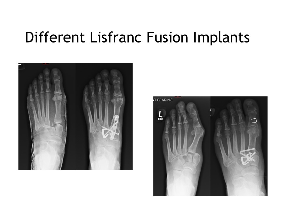 Different Lisfranc Fusion Implants