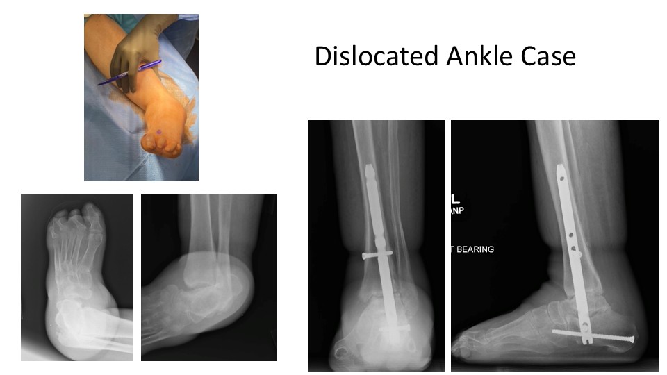 Dislocated Ankle Case