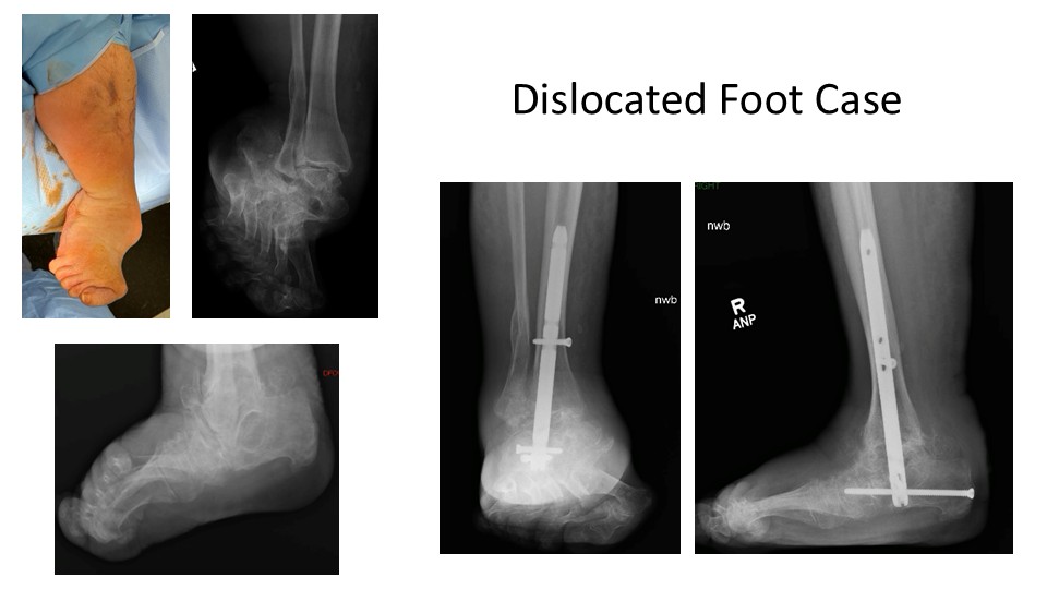 Dislocated Foot Case
