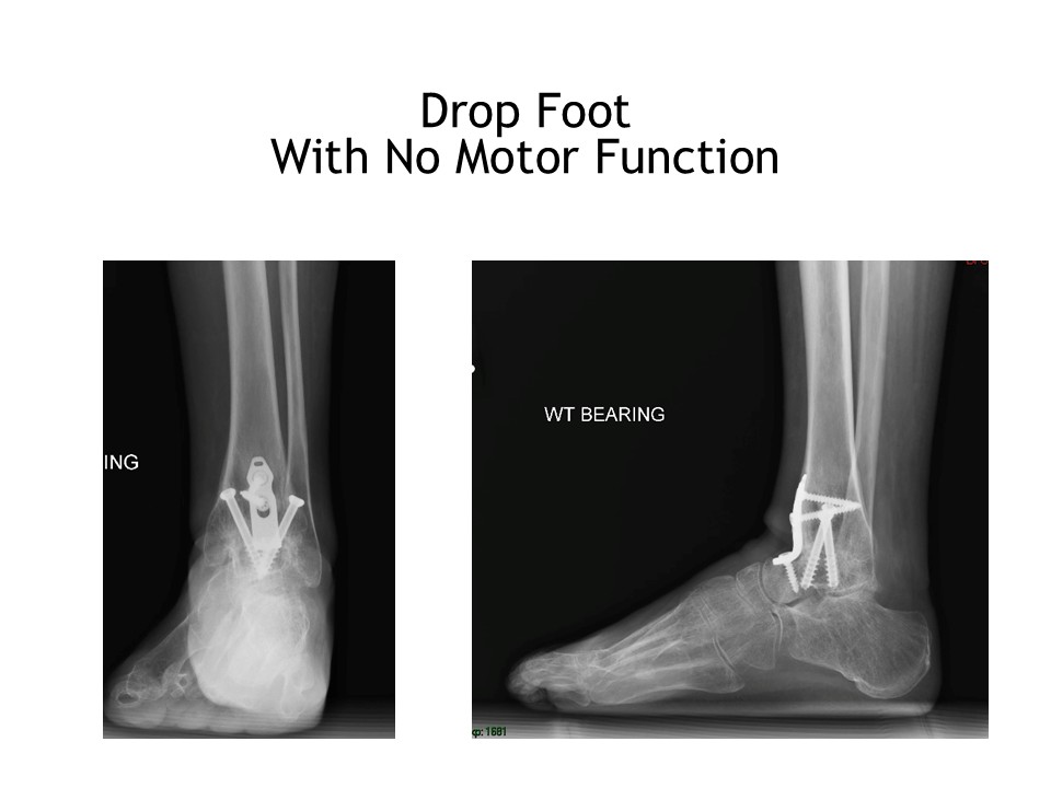 Drop Foot With No Motor Function