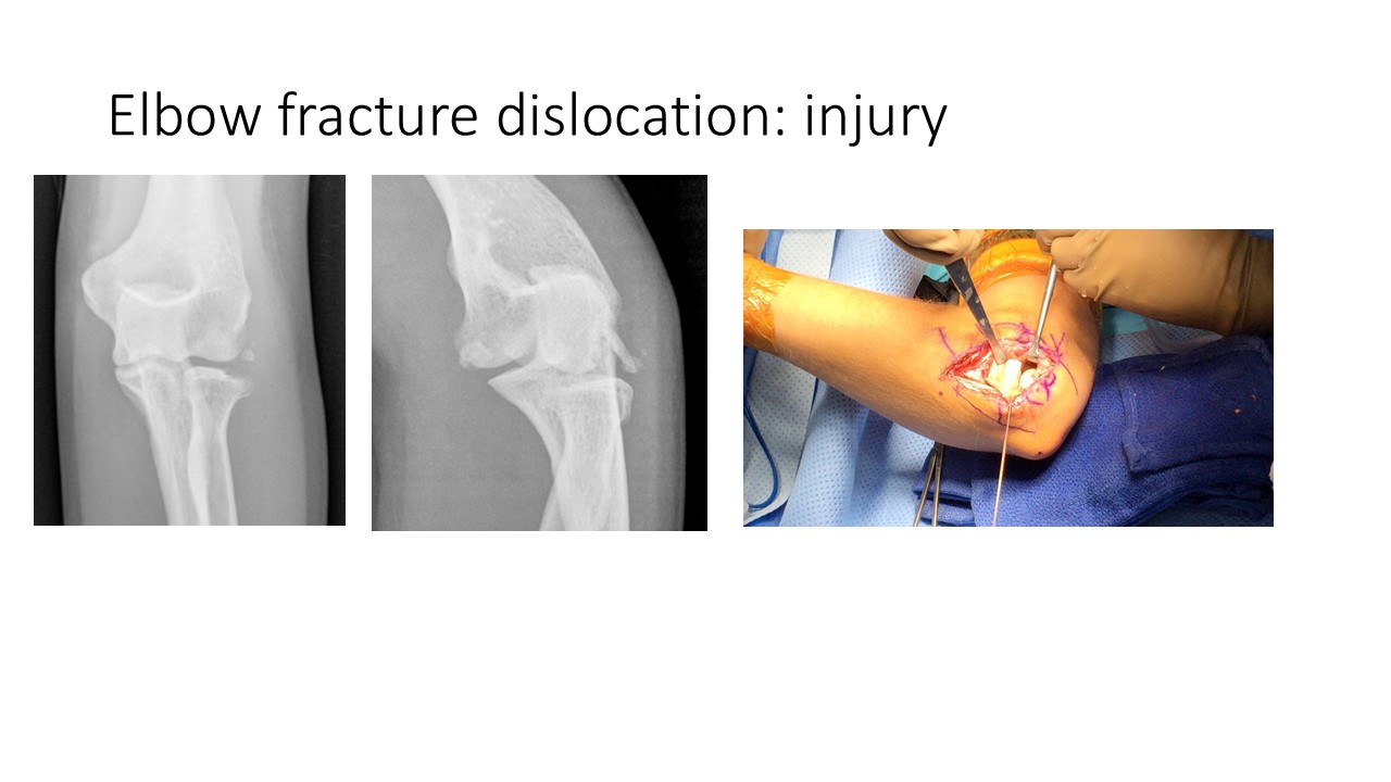 Elbow Fracture Dislocation Injury