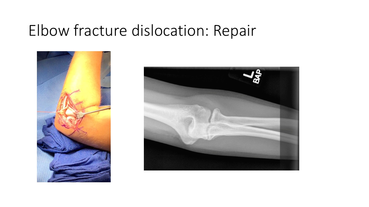 Elbow Fracture Dislocation Repair