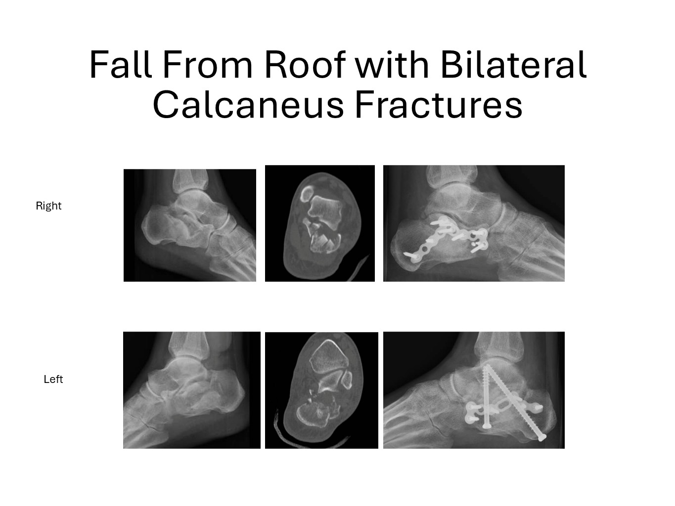 Fall From Roof With Bilateral Calcaneus Fractures