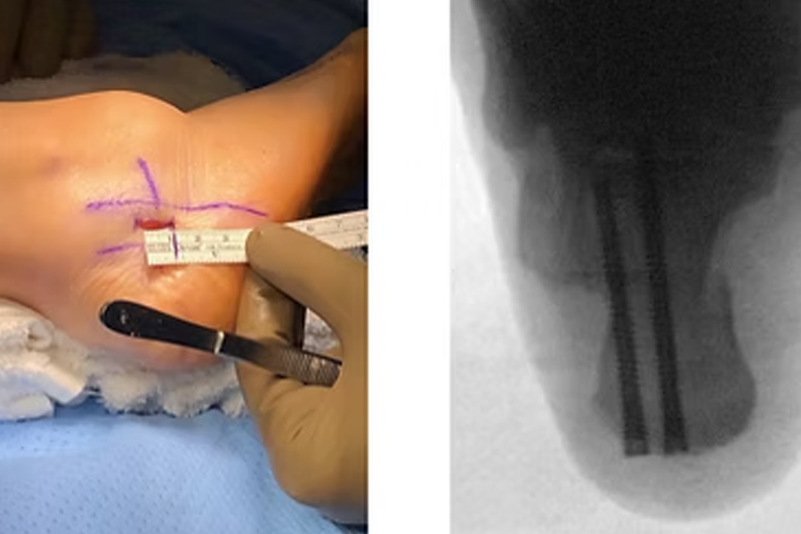 Flatfoot Repair Fixation