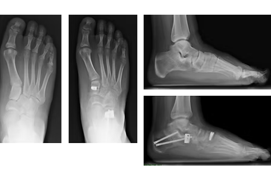 Flatfoot Repair Fixation