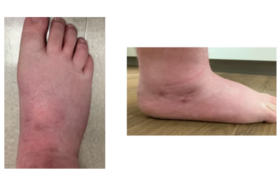 Flatfoot Repair Fixation